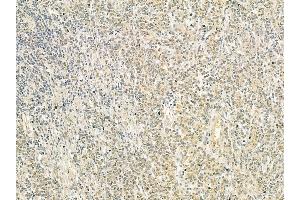 PPP1R7 Mouse Monoclonal Antibody at 1/100 staining human gastric cancer by IHC-P. (PPP1R7 抗体  (C-Term))