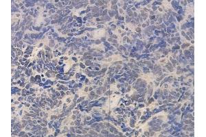 ABIN6260723 and ABIN6276724 at 1/100 staining human small cell lung carcinoma by IHC-P.
