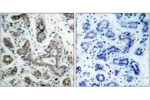 Immunohistochemistry analysis of paraffin-embedded human breast carcinoma tissue, using PDK1 (Ab-241) Antibody. (PDPK1 抗体  (AA 210-259))