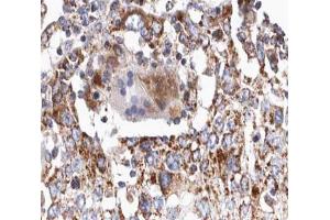 ABIN6266641 at 1/100 staining human lung carcinoma tissue sections by IHC-P. (TGFB2 抗体  (C-Term))