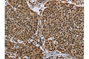 The image on the left is immunohistochemistry of paraffin-embedded Human cervical cancer tissue using ABIN7130674(PPAT Antibody) at dilution 1/50, on the right is treated with fusion protein. (PPAT 抗体)