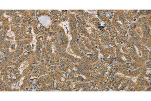 Immunohistochemistry of paraffin-embedded Human thyroid cancer using SDHB Polyclonal Antibody at dilution of 1:30 (SDHB 抗体)