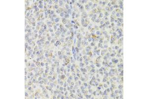 Immunohistochemistry of paraffin-embedded human B cell lymphoma using CD74 Antibody (ABIN5973310) at dilution of 1/100 (40x lens). (CD74 抗体)