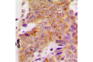 Immunohistochemical analysis of S6K1 (pS418) staining in human breast cancer formalin fixed paraffin embedded tissue section.