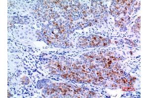 Immunohistochemistry (IHC) analysis of paraffin-embedded Human Mammary Cancer, antibody was diluted at 1:100. (pan Keratin 抗体  (pan))
