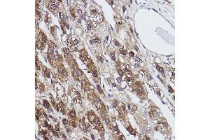 Immunohistochemistry of paraffin-embedded human liver cancer using FBP1 Rabbit mAb (ABIN7267269) at dilution of 1:100 (40x lens). (FBP1 抗体)