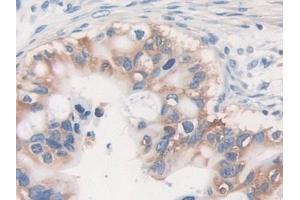 Detection of MVP in Human Bile duct cancer Tissue using Polyclonal Antibody to Major Vault Protein (MVP) (MVP 抗体  (AA 2-272))