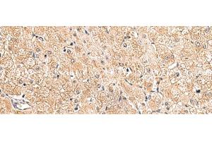 Immunohistochemistry of paraffin-embedded Human liver cancer tissue using LRG1 Polyclonal Antibody at dilution of 1:80(x200) (LRG1 抗体)
