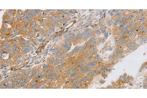 Immunohistochemistry of paraffin-embedded Human breast cancer using STX16 Polyclonal Antibody at dilution of 1:30 (Syntaxin 16 抗体)