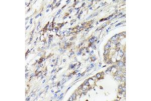 Immunohistochemistry of paraffin-embedded human lung cancer using IL1A Rabbit pAb (ABIN6129280, ABIN6142331, ABIN6142332 and ABIN6217051) at dilution of 1:100 (40x lens). (IL1A 抗体  (AA 112-271))