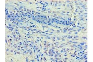 Immunohistochemistry of paraffin-embedded human breast cancer using ABIN7155327 at dilution of 1:100 (HDAC8 抗体  (AA 1-377))