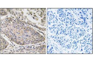 Immunohistochemistry analysis of paraffin-embedded human lung carcinoma tissue using PLA2G4E antibody. (PLA2G4E 抗体)