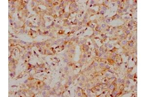 IHC image of ABIN7127380 diluted at 1:118 and staining in paraffin-embedded human liver cancer performed on a Leica BondTM system. (Recombinant CA9 抗体)