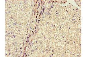 Immunohistochemistry of paraffin-embedded human liver cancer using ABIN7159937 at dilution of 1:100 (BRP44 抗体  (AA 1-40))