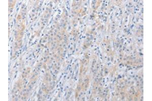 The image on the left is immunohistochemistry of paraffin-embedded Human gastric cancer tissue using ABIN7131038(SERPINE2 Antibody) at dilution 1/20, on the right is treated with fusion protein. (SERPINE2 抗体)