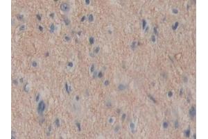 Detection of ENPEP in Human Glioma Tissue using Polyclonal Antibody to Aminopeptidase A (ENPEP) (ENPEP 抗体  (AA 718-948))