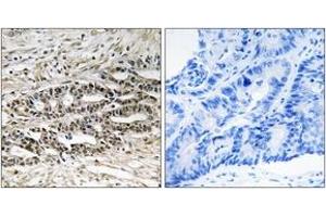 Immunohistochemistry analysis of paraffin-embedded human colon carcinoma tissue, using MDM4 (Ab-367) Antibody. (MDM4-binding Protein 抗体  (AA 336-385))