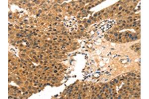 The image on the left is immunohistochemistry of paraffin-embedded Human breast cancer tissue using ABIN7191443(MED14 Antibody) at dilution 1/20, on the right is treated with synthetic peptide. (MED14 抗体)
