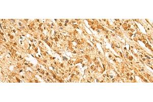 Immunohistochemistry of paraffin-embedded Human prost ate cancer tissue using SSSCA1 Polyclonal Antibody at dilution of 1:50(x200) (SSSCA1 抗体)