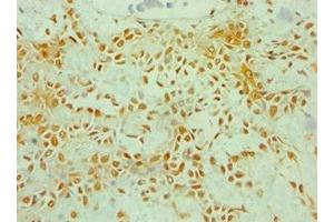 Immunohistochemistry of paraffin-embedded human breast cancer using ABIN7176253 at dilution of 1:100 (ZNF346 抗体  (AA 1-294))