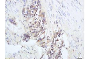 Formalin-fixed and paraffin embedded human colon cancer labeled with Anti-phospho-RAC1(Ser71) Polyclonal Antibody, Unconjugated  at 1:200 followed by conjugation to the secondary antibody and DAB staining (RAC1 抗体  (pSer71))