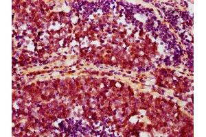 IHC image of ABIN7127677 diluted at 1:100 and staining in paraffin-embedded human lung cancer performed on a Leica BondTM system. (Recombinant AKT1 抗体  (pSer473))