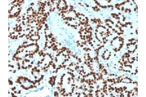 IHC testing of FFPE human prostate carcinoma with FOXA1 antibody (clone FOXA1/1518). (FOXA1 抗体  (AA 372-472))