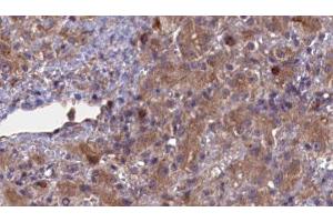 ABIN6276936 at 1/100 staining Human liver cancer tissue by IHC-P. (ABCG8 抗体  (Internal Region))