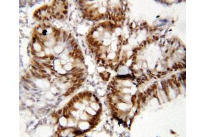 Anti-FOXP1 antibody, IHC(P) IHC(P): Human Rectal Cancer Tissue (FOXP1 抗体  (C-Term))