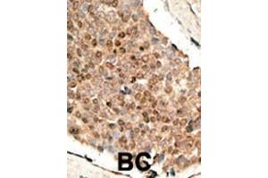 Formalin-fixed and paraffin-embedded human cancer tissue reacted with the primary antibody, which was peroxidase-conjugated to the secondary antibody, followed by DAB staining. (BMP10 抗体  (N-Term))