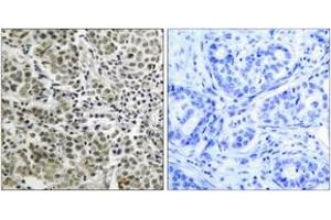 Immunohistochemistry analysis of paraffin-embedded human prostate carcinoma tissue, using Androgen Receptor (Ab-650) Antibody. (Androgen Receptor 抗体  (AA 621-670))