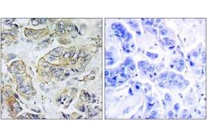 Immunohistochemistry analysis of paraffin-embedded human breast carcinoma tissue, using NPY5R Antibody. (NPY5R 抗体  (AA 221-270))