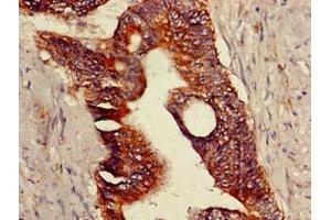 Immunohistochemistry of paraffin-embedded human colon cancer using ABIN7172875 at dilution of 1:100 (TRPV1 抗体  (AA 1-155))