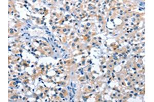 The image on the left is immunohistochemistry of paraffin-embedded Human thyroid cancer tissue using ABIN7128547(ASB2 Antibody) at dilution 1/50, on the right is treated with fusion protein.