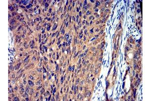 Immunohistochemical analysis of paraffin-embedded ROP1 tissues using cervical cancer mouse mAb with DAB staining. (ROP1 (AA 42-183) 抗体)
