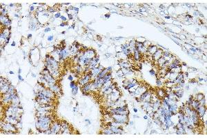 Immunohistochemistry of paraffin-embedded Human colon carcinoma using TRAP1 Polyclonal Antibody at dilution of 1:100 (40x lens). (TRAP1 抗体)