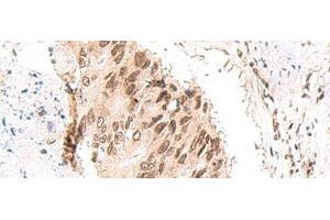 Immunohistochemistry of paraffin-embedded Human colorectal cancer tissue using CKMT1A/CKMT1B Polyclonal Antibody at dilution of 1:55(x200) (CKMT1 抗体)