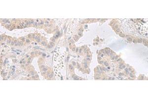 Immunohistochemistry of paraffin-embedded Human thyroid cancer tissue using GPRASP2 Polyclonal Antibody at dilution of 1:35(x200) (GPRASP2 抗体)