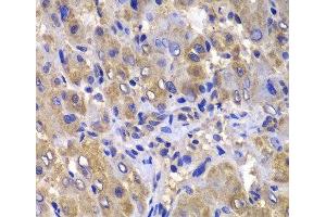 Immunohistochemistry of paraffin-embedded Human liver damage using CARD10 Polyclonal Antibody at dilution of 1:100 (40x lens). (CARD10 抗体)