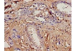 Immunohistochemistry analysis of human breast cancer using ABIN7164734 at dilution of 1:100 (PIP 抗体  (AA 29-146))