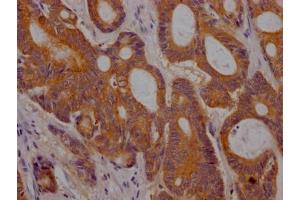 IHC image of ABIN7127772 diluted at 1:100 and staining in paraffin-embedded human colon cancer performed on a Leica BondTM system. (Recombinant PLGF 抗体)