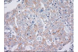 Immunohistochemical staining of paraffin-embedded Carcinoma of liver tissue using anti-KRT19mouse monoclonal antibody. (Cytokeratin 19 抗体  (AA 240-390))