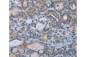 Immunohistochemistry of Human thyroid cancer using HOMER1 Polyclonal Antibody at dilution of 1:50 (HOMER1 抗体)