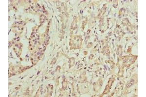Immunohistochemistry of paraffin-embedded human pancreatic cancer using ABIN7145484 at dilution of 1:100 (DEFB129 抗体  (AA 20-183))