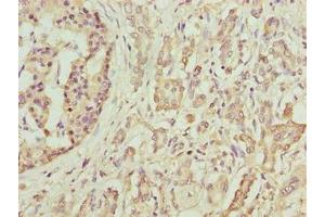 Immunohistochemistry of paraffin-embedded human pancreatic cancer using ABIN7145484 at dilution of 1:100 (DEFB129 抗体  (AA 20-183))