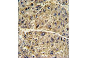 Formalin-fixed and paraffin-embedded human hepatocarcinoma with COL6A1 Antibody (N-term), which was peroxidase-conjugated to the secondary antibody, followed by DAB staining. (COL6A1 抗体  (N-Term))