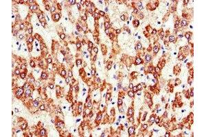 Immunohistochemistry of paraffin-embedded human liver cancer using ABIN7144836 at dilution of 1:100 (ATP5F1A (AA 59-257) 抗体)