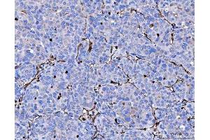 IHC analysis of Vimentin using anti-Vimentin antibody (ABIN3042344).