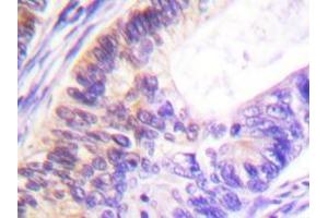 Immunohistochemistry analyzes of Rsk-1 antibody in paraffin-embedded human colon carcinoma tissue. (RPS6KA1 抗体)
