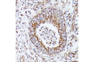 Immunohistochemistry of paraffin-embedded human colon carcinoma using DLAT antibody (ABIN7266768) at dilution of 1:100 (40x lens). (DLAT 抗体  (AA 87-270))